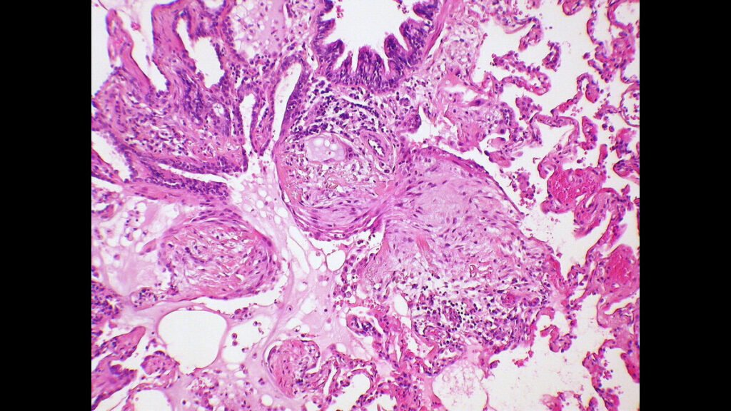 chromophobe renal cell cancer