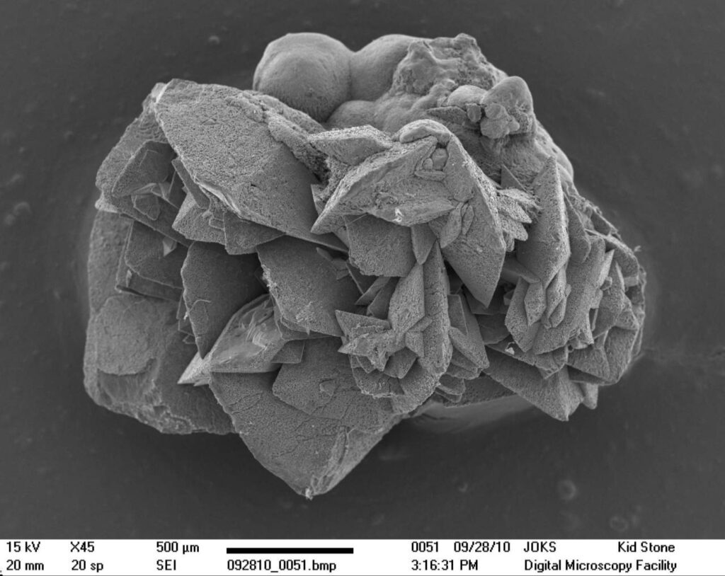Kidney stone under microscope