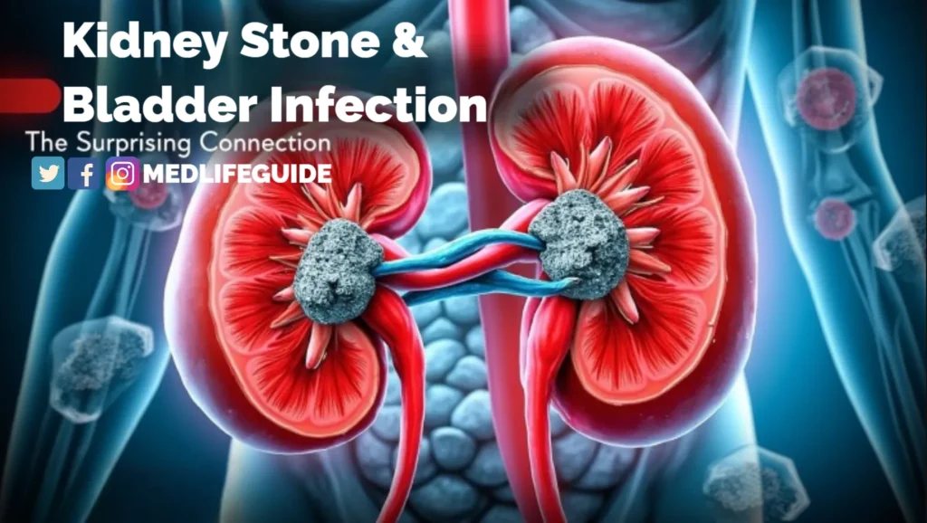 Can Kidney Stones Cause Bladder Infection