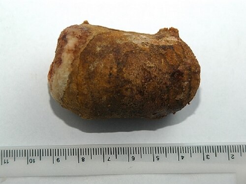 Kidney stone size in mm
