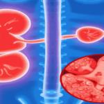 kidney stone pain in clitorus