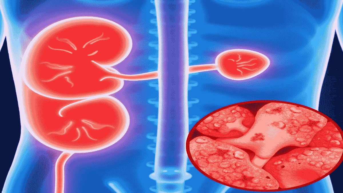 kidney stone pain in clitorus