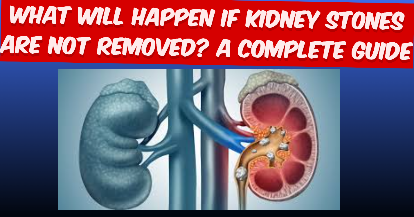 What Will Happen If Kidney Stones Are Not Removed A Complete Guide