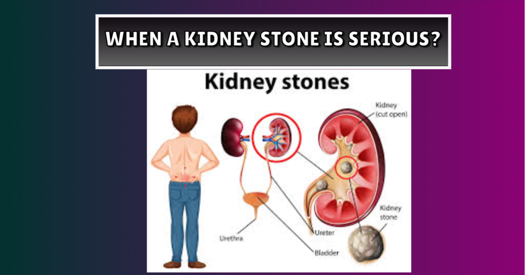 When a Kidney Stone Is Serious