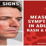 Measles Symptoms in Adults explained by medlifeguide