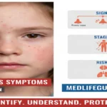 Measles Symptoms in Children by medlifeguide