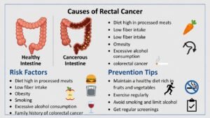 Rectal Cancer Causes Key Risks & Prevention Tips