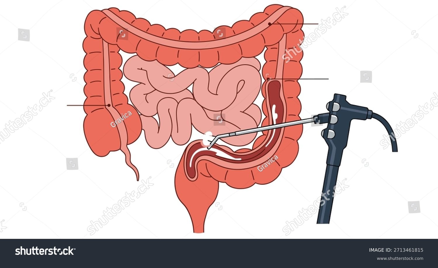 Unlabeled Medical Diagram Colonoscopy Procedure Endoscope Stock ...