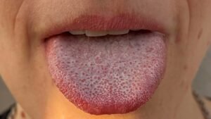 Persistent Taste Loss After COVID Cause Identified Study