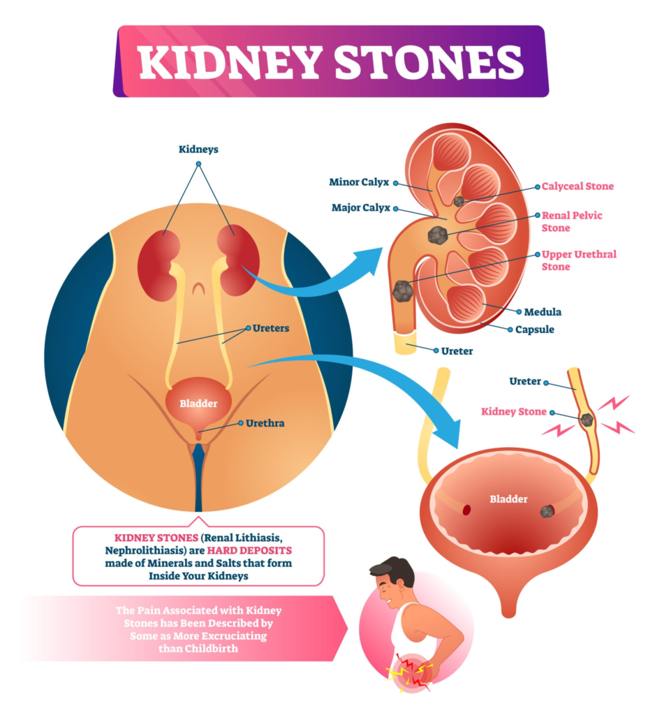 Anatomy of Renal Calculi. Source: VectorMine / Getty Images