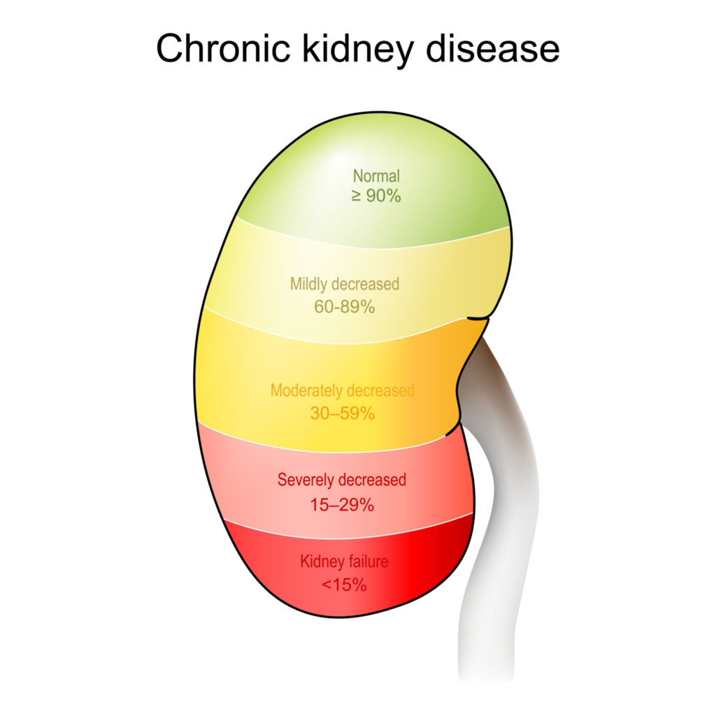 Chronic Kidney Disease Stages. Source: ttsz / Getty Images