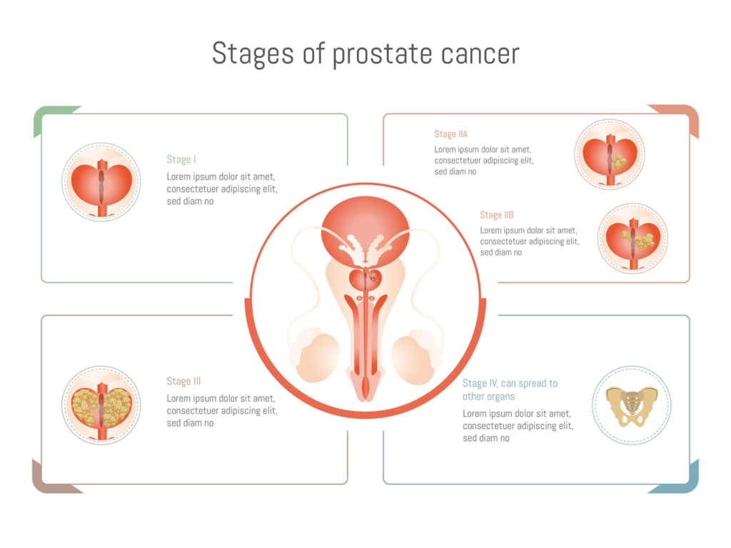 Prostate cancer progression stages. Source: Maria Pilar Martinez Aguerri / Getty Images